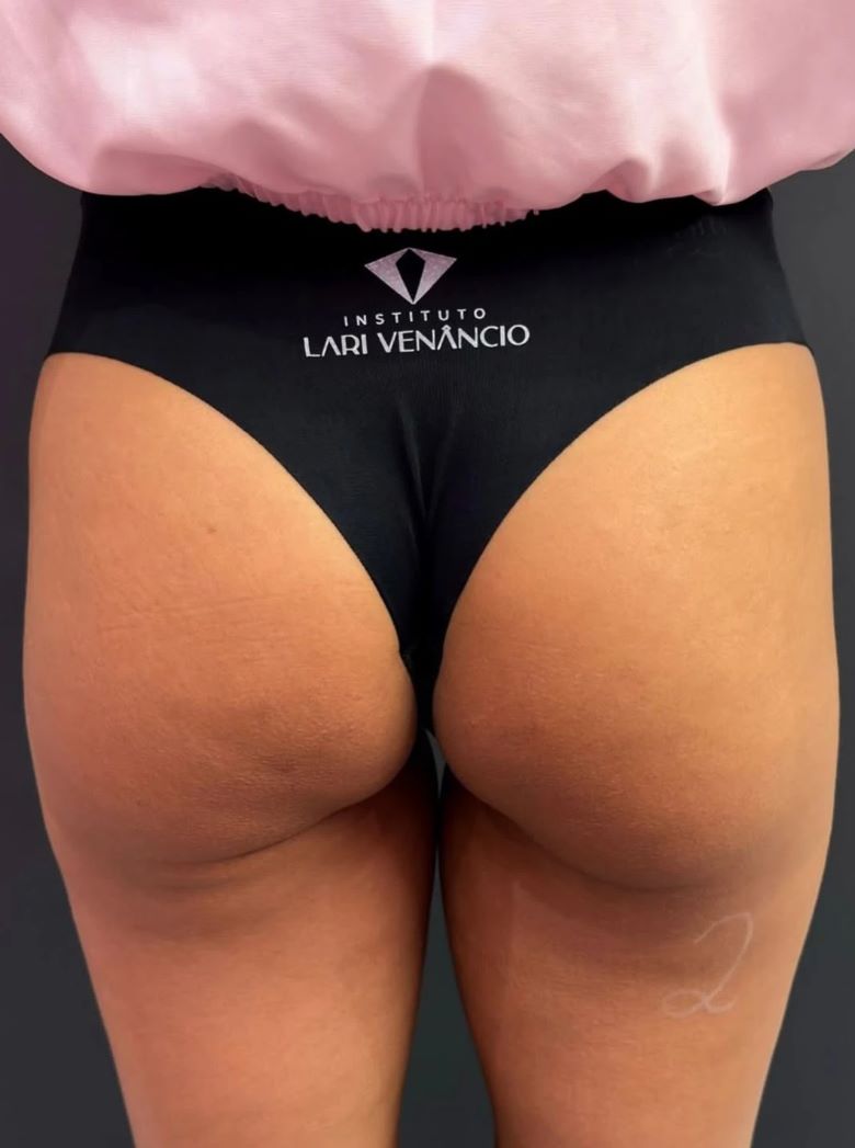 Antes da harmonização de glúteo, segundo caso