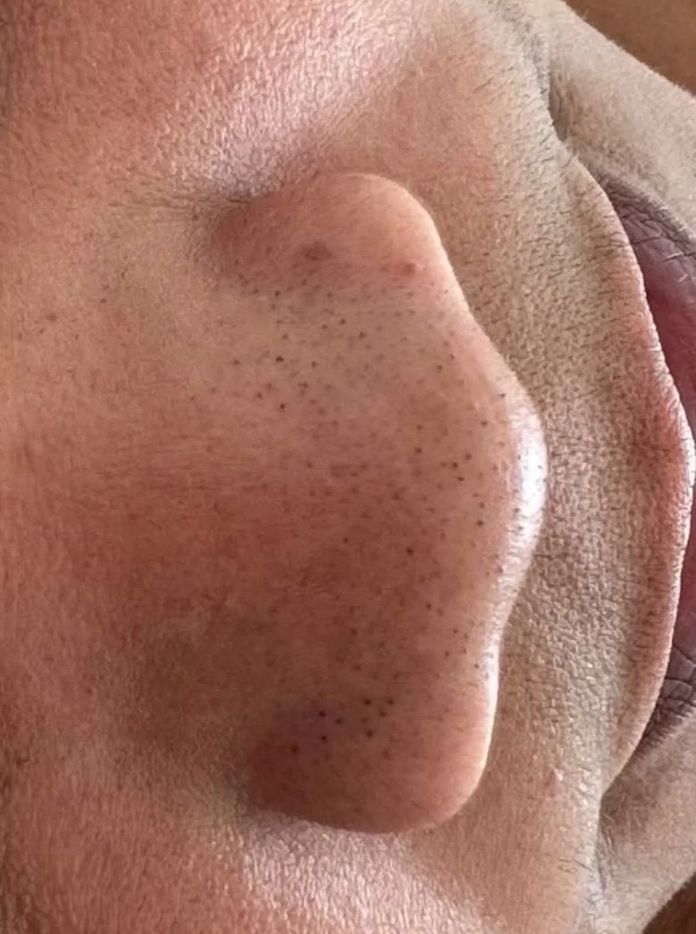 Antes da limpeza de pele: cravos e poros obstruídos no nariz