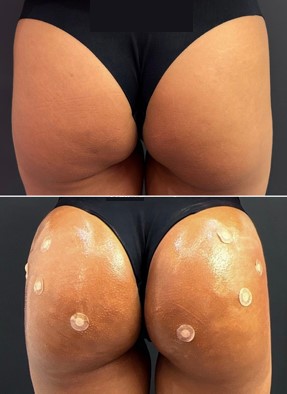 Antes (em cima) e depois (embaixo) do ácido hialurônico para glúteos: glúteos com mais volume e contorno