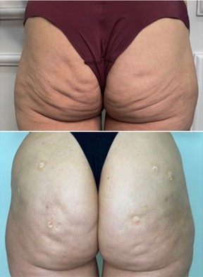 Antes (em cima) e depois (embaixo) do bioestimulador de colágeno para glúteos: pele mais firme e com menos flacidez